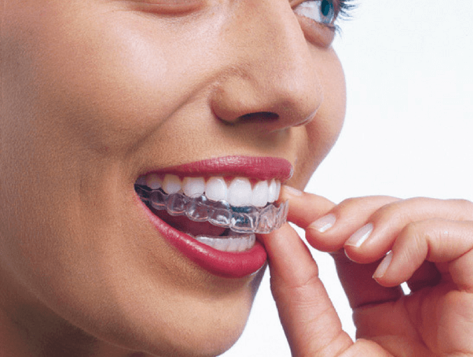 Want beautiful straight teeth without braces? – Spring has sprung with Invisalign at Spa Dental
