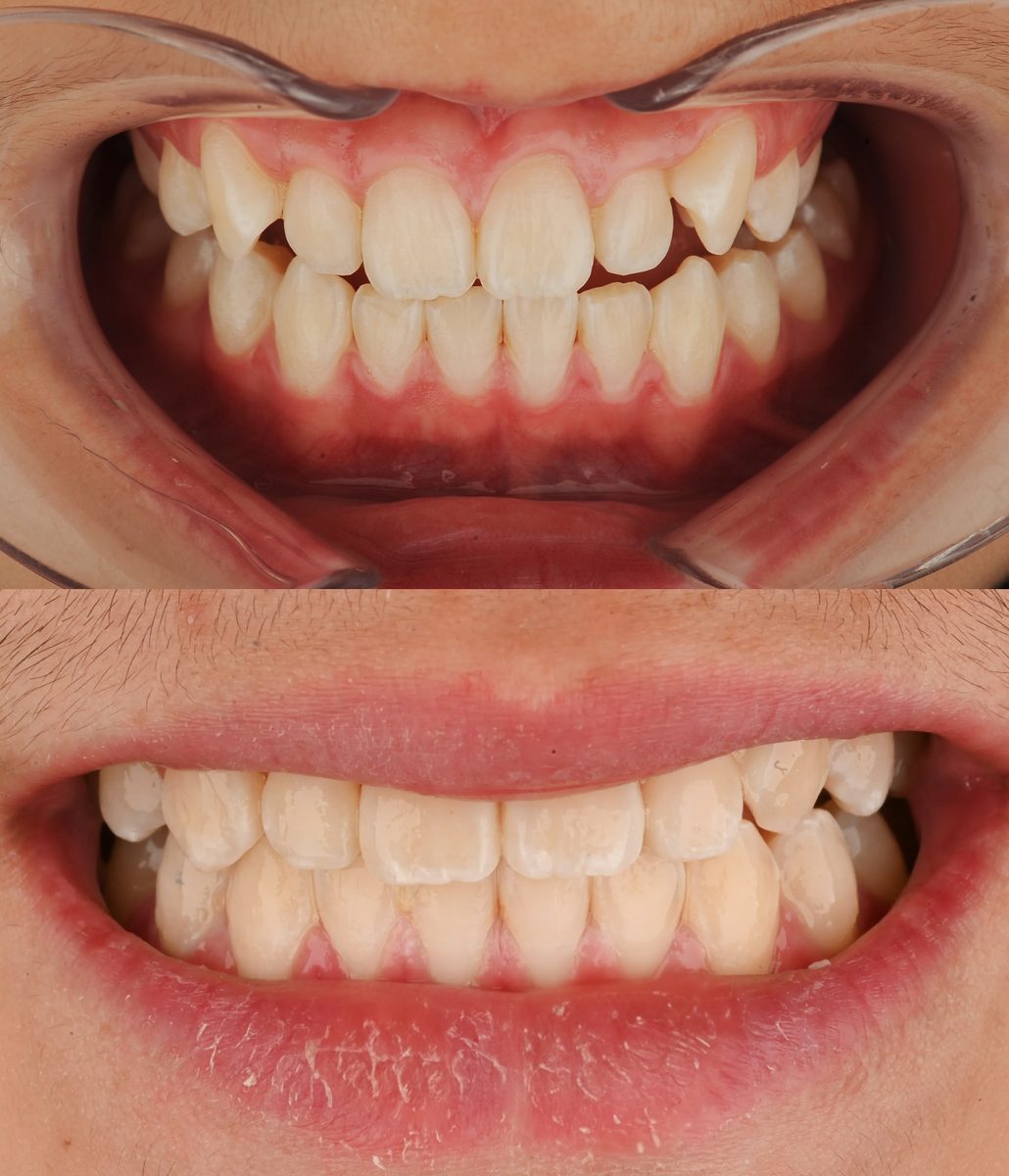 Before and after: Invisalign®