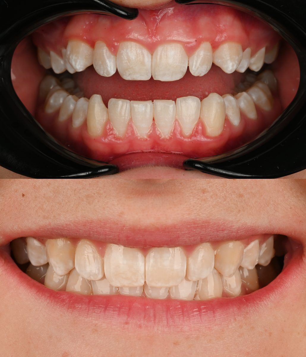 Before and after: Invisalign®