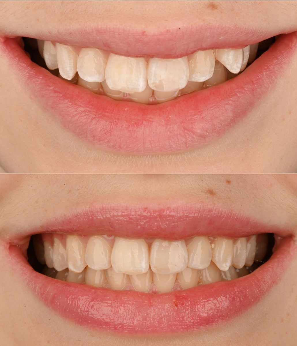 Before and after: Invisalign®
