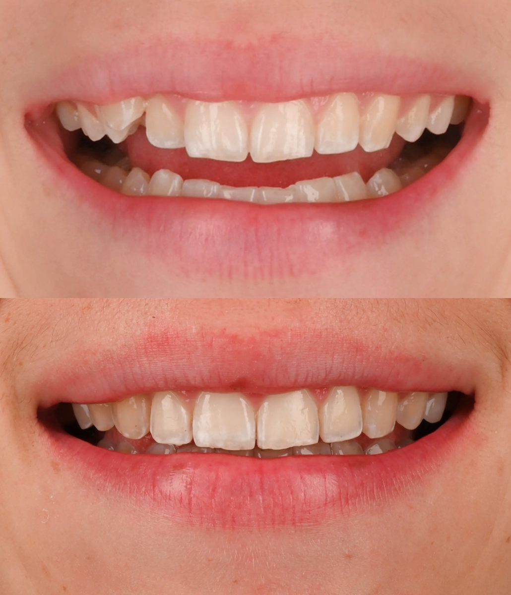 Before and after: Invisalign®