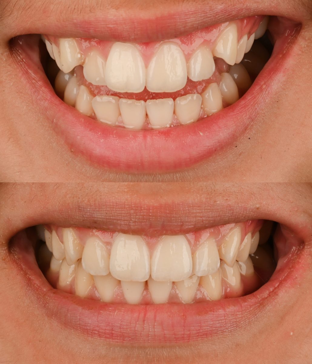 Before and after: Invisalign®