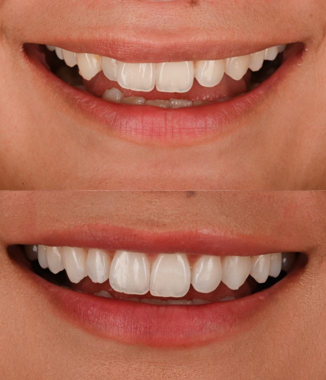 Before and after: Invisalign®, Composite Bonding