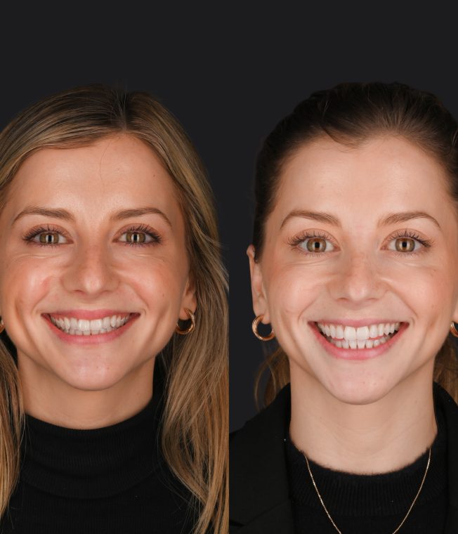 Before and after: Invisalign®, Composite Bonding