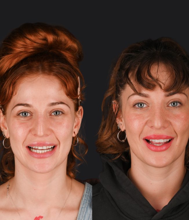 Before and after: Invisalign®, Composite Bonding