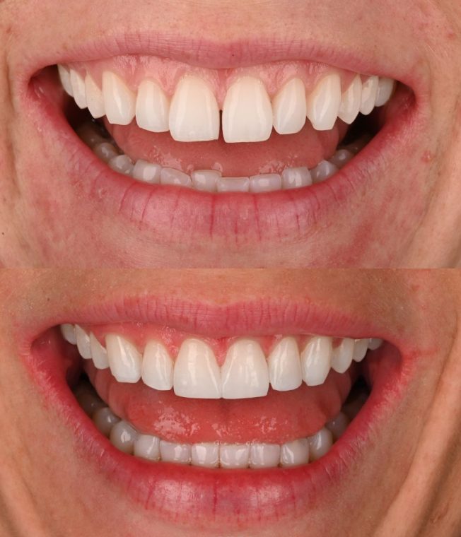 Before and after: Invisalign®, Composite Bonding