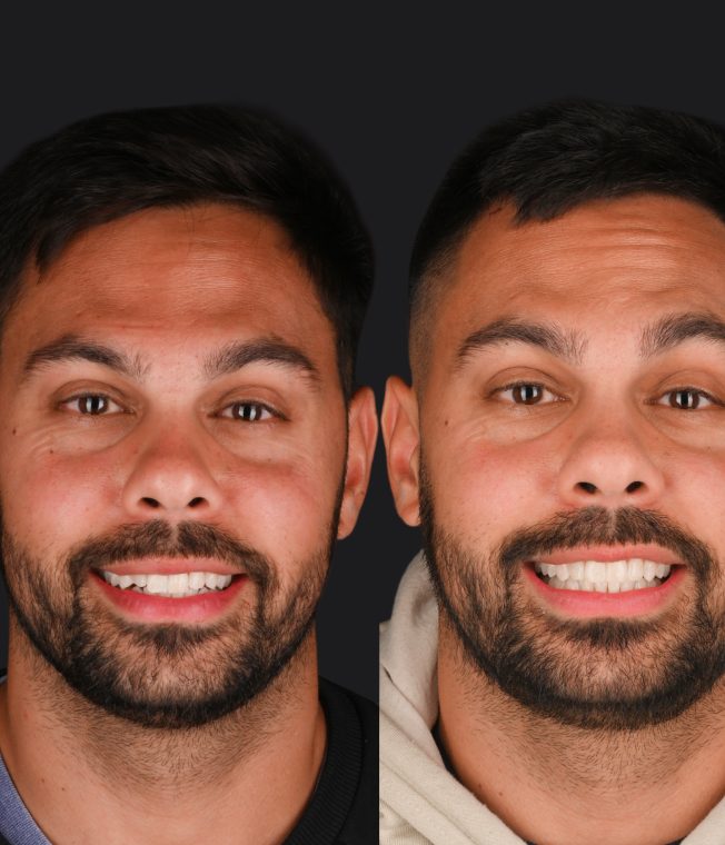 Before and after: Invisalign®, Composite Bonding