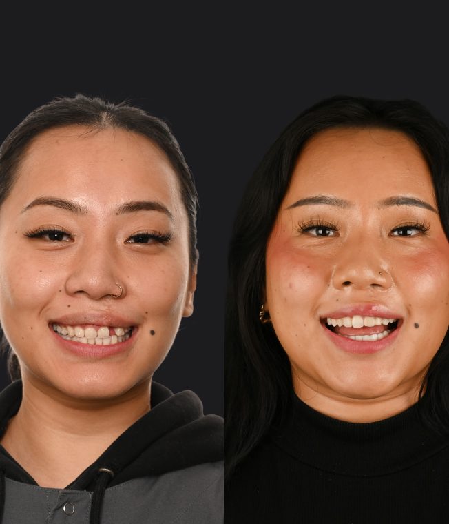 Before and after: Gum Lift, Veneers
