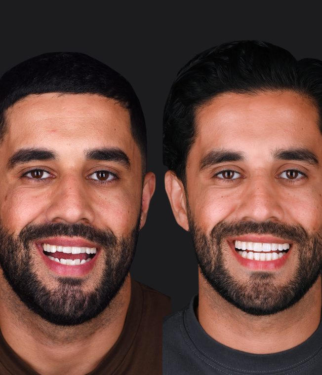 Before and after: Invisalign®, Teeth Whitening, Composite Bonding