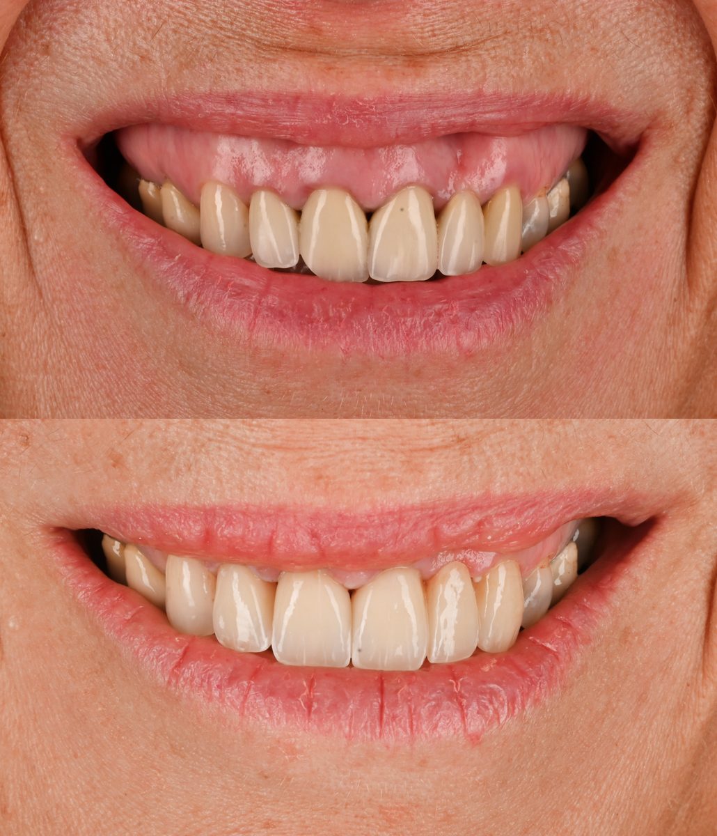 Before and after: Veneers