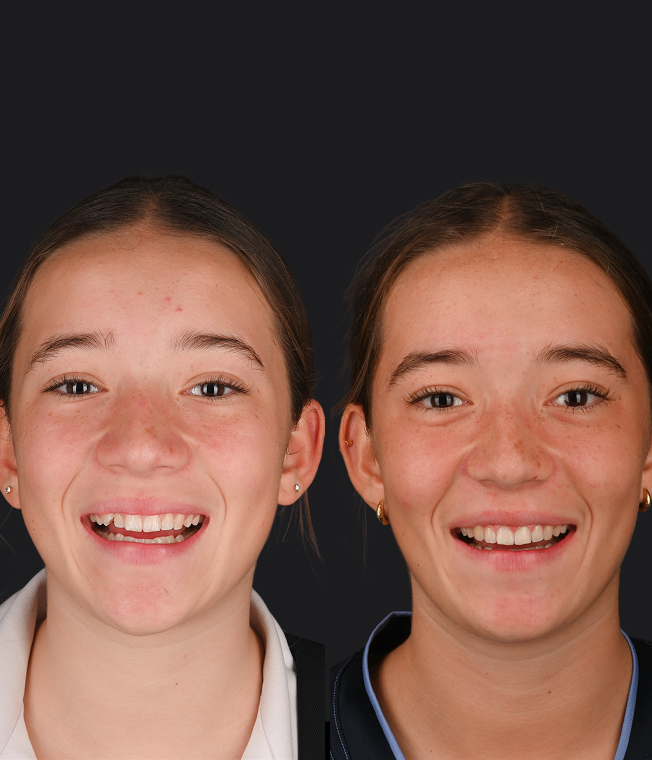 Invisalign® patient, before and after