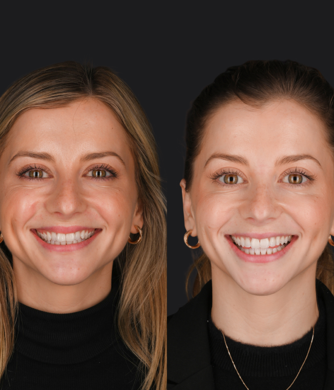 Invisalign® & Composite Bonding patient, before and after