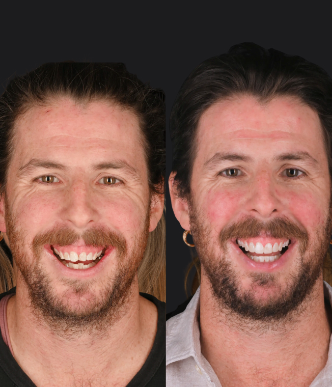 Invisalign® & Composite Bonding patient, before and after