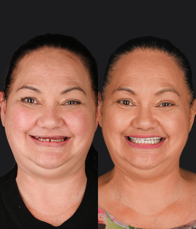 Dental Implants patient, before and after