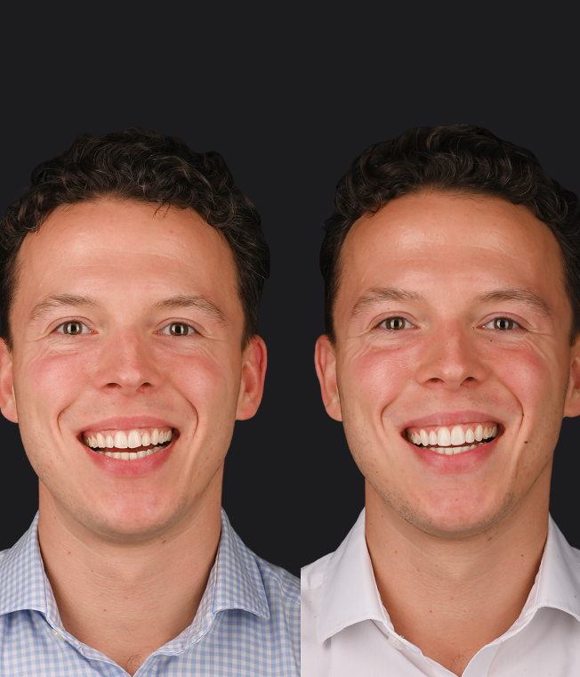 Composite Edge Bonding patient, before and after