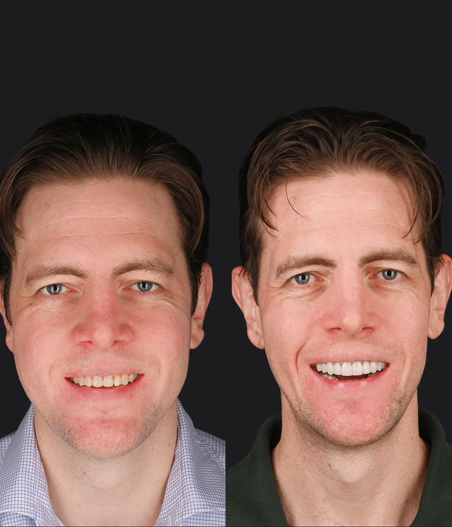 Sear Veneers patient, before and after