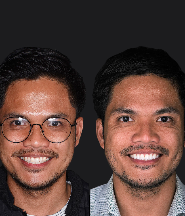 Veneers & Composite Whitening patient, before and after
