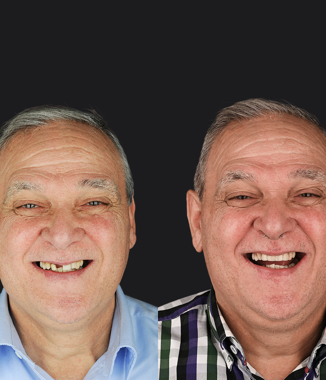 Dental Implants patient, before and after