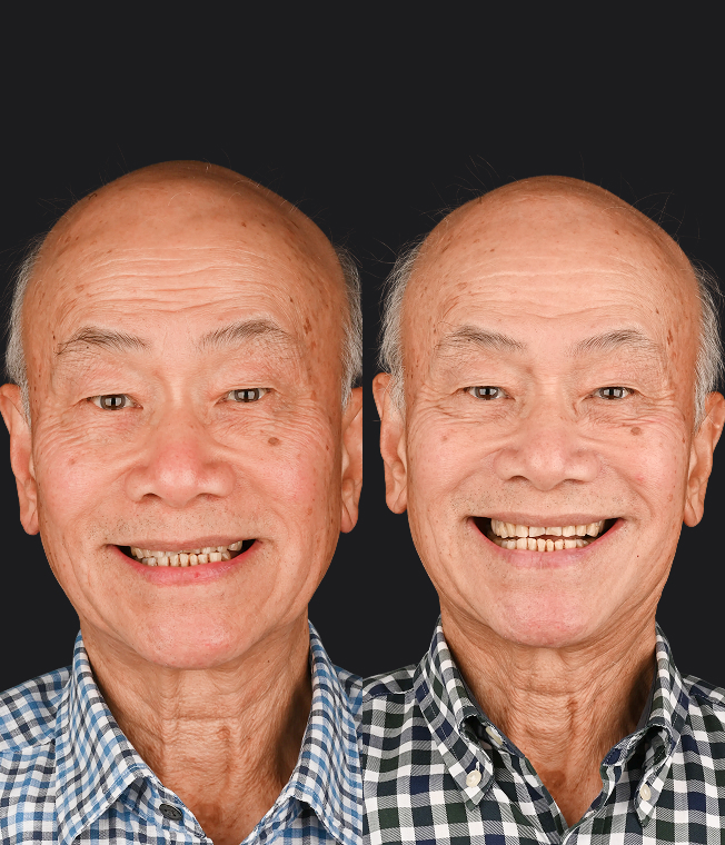 Dental Implants patient, before and after