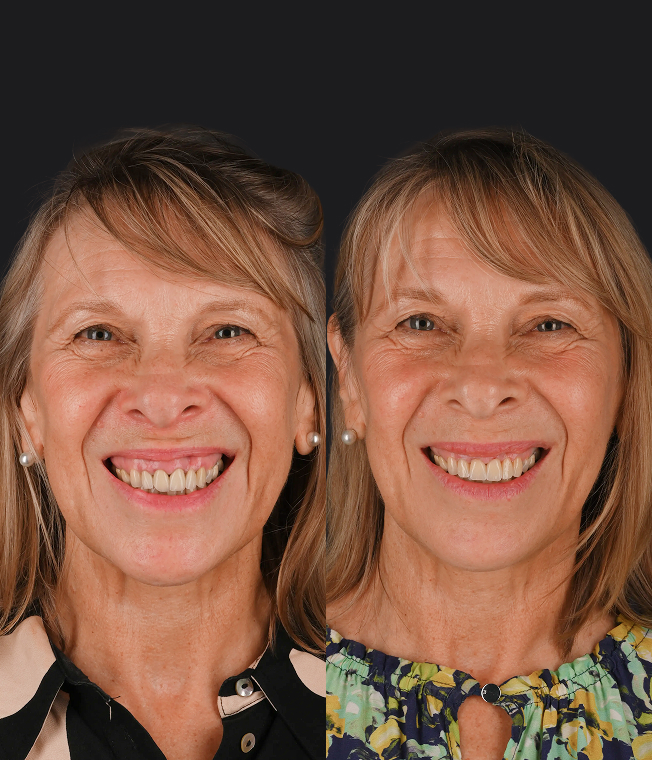 Porcelain Veneers patient, before and after