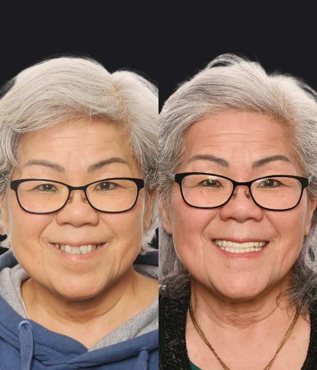 Dental Implants patient, before and after