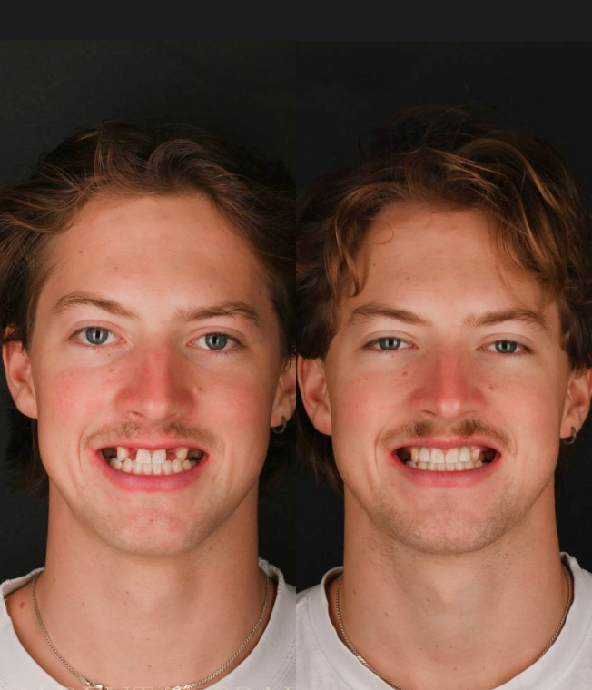 Dental Implants patient, before and after