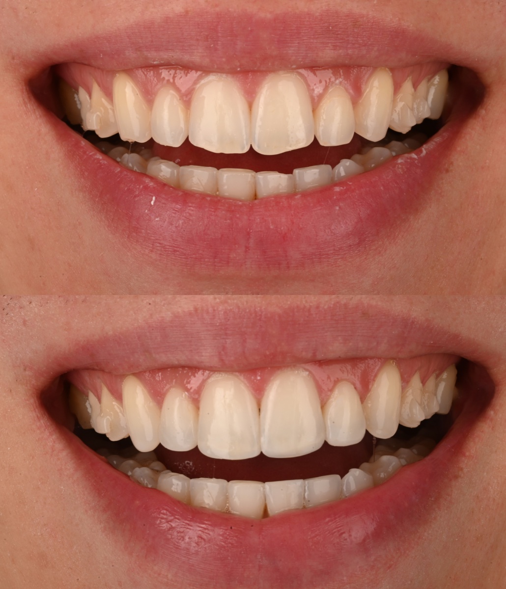 Composite Bonding patient 1 patient, before and after