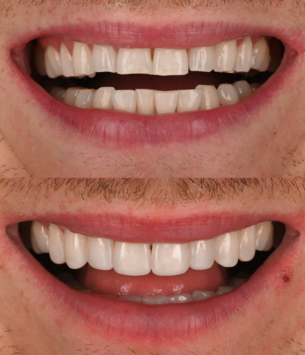 Composite Bonding patient 2 patient, before and after