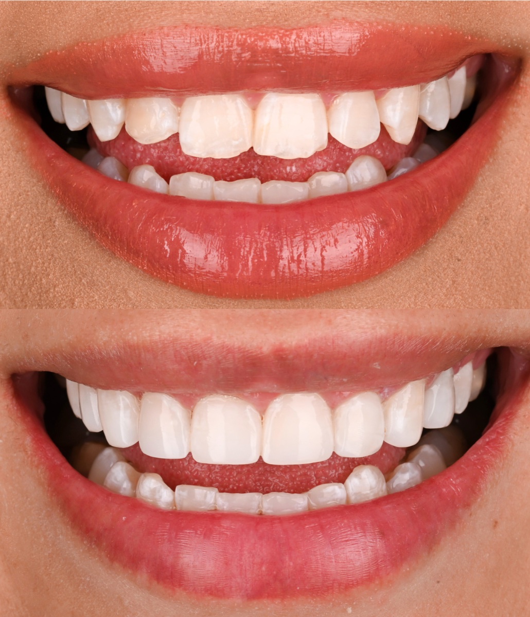 Composite Bonding patient 3 patient, before and after