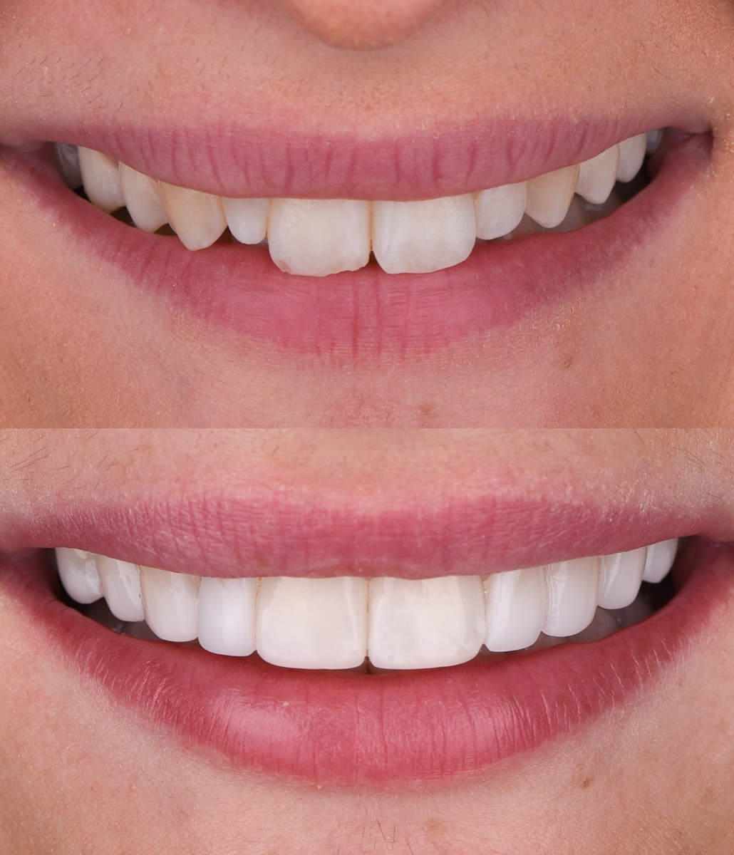 Composite Bonding patient 4 patient, before and after