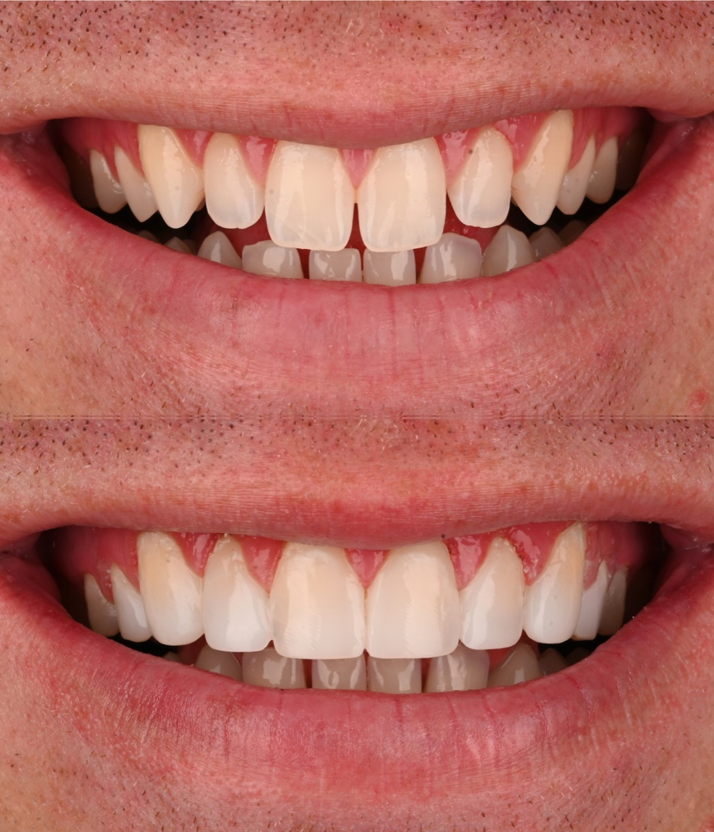 Composite Bonding patient 5 patient, before and after