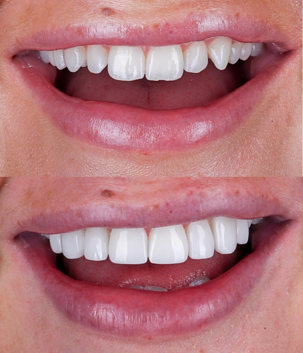 Composite Bonding patient 6 patient, before and after