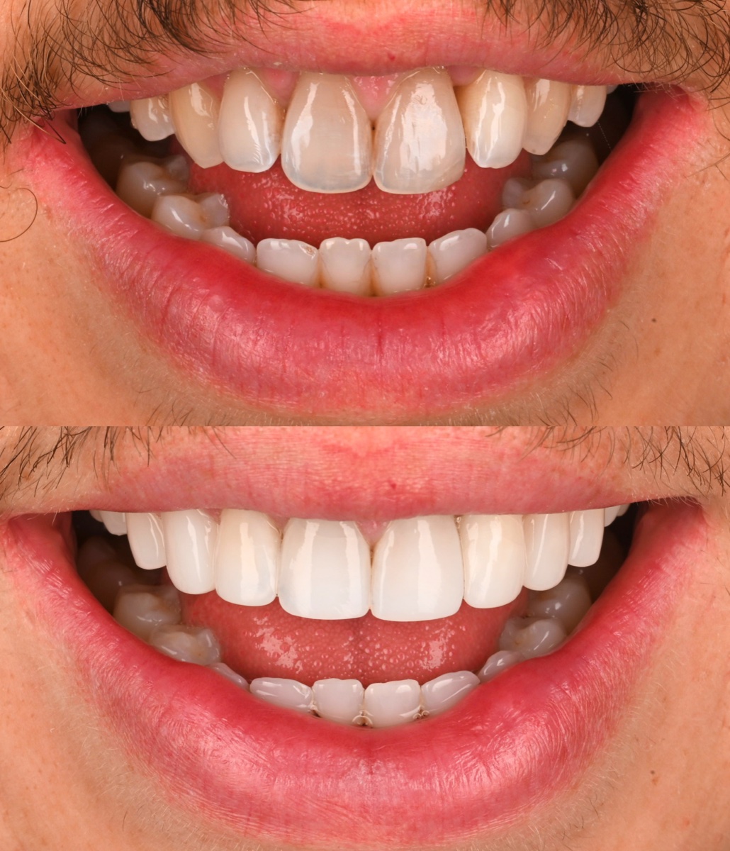 Composite Bonding patient 7 patient, before and after
