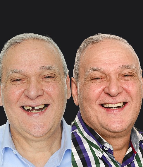 Silvano patient, before and after