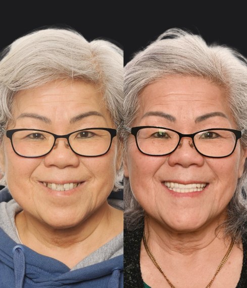 Wendy patient, before and after