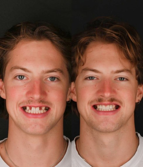 Woolley patient, before and after