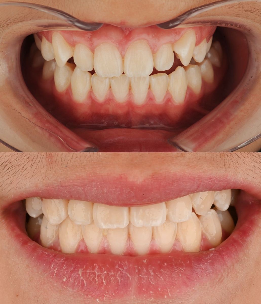 Invisalign® patient 1 patient, before and after