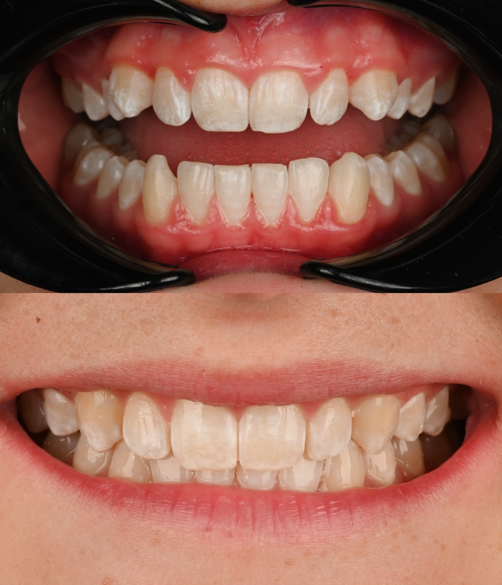 Invisalign® patient 2 patient, before and after