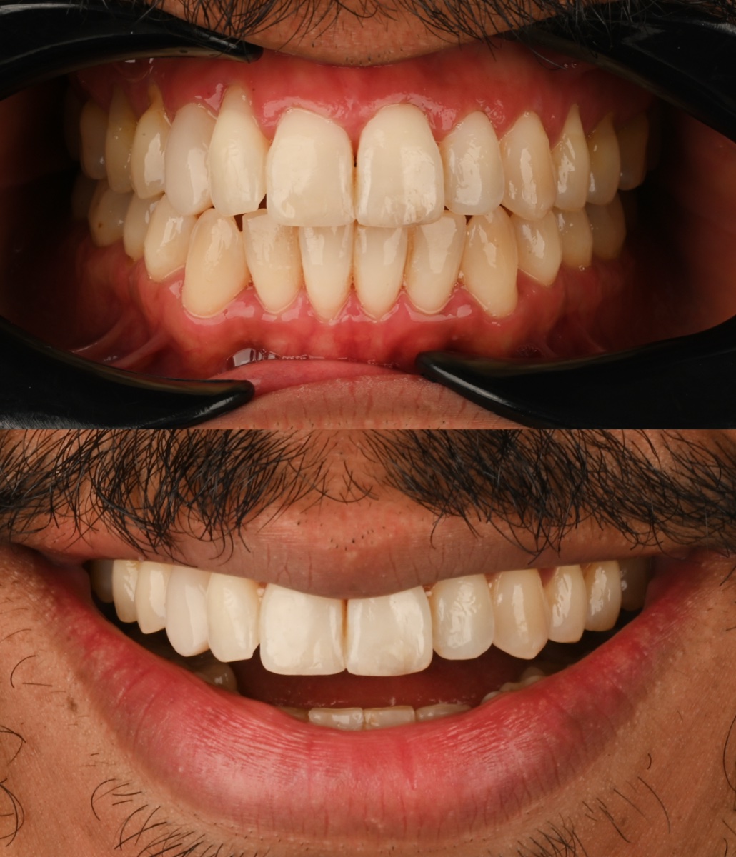Invisalign® patient 3 patient, before and after