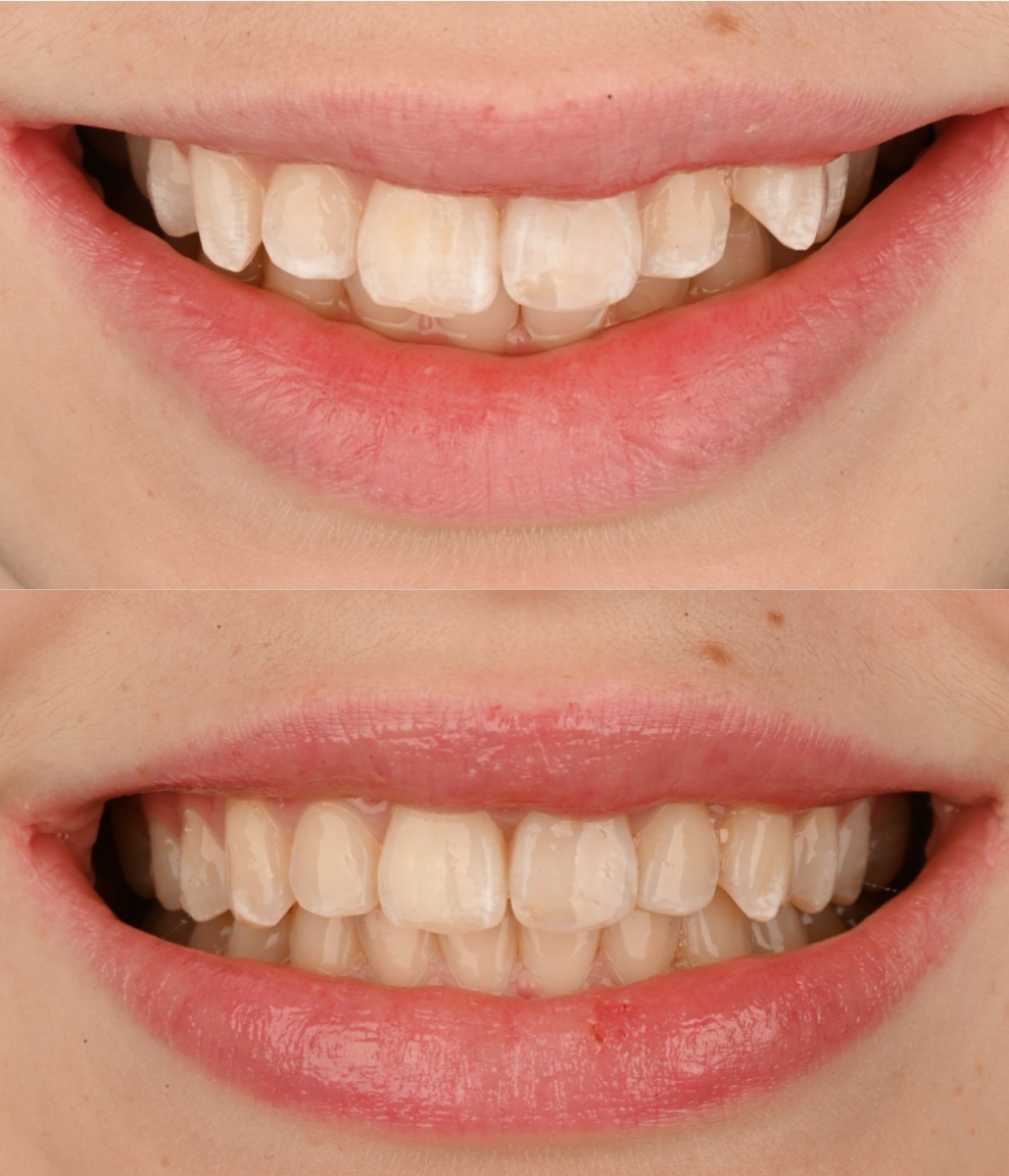 Invisalign® patient 4 patient, before and after