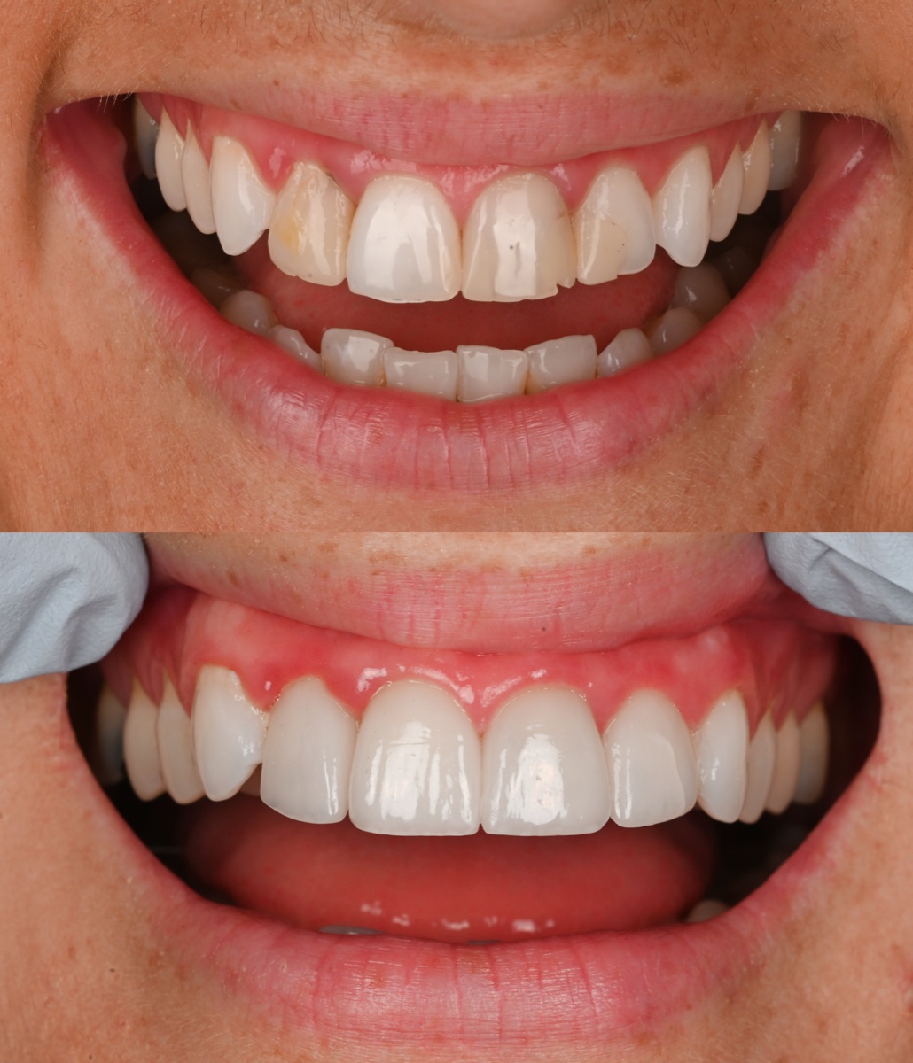 Veneers patient 1 patient, before and after