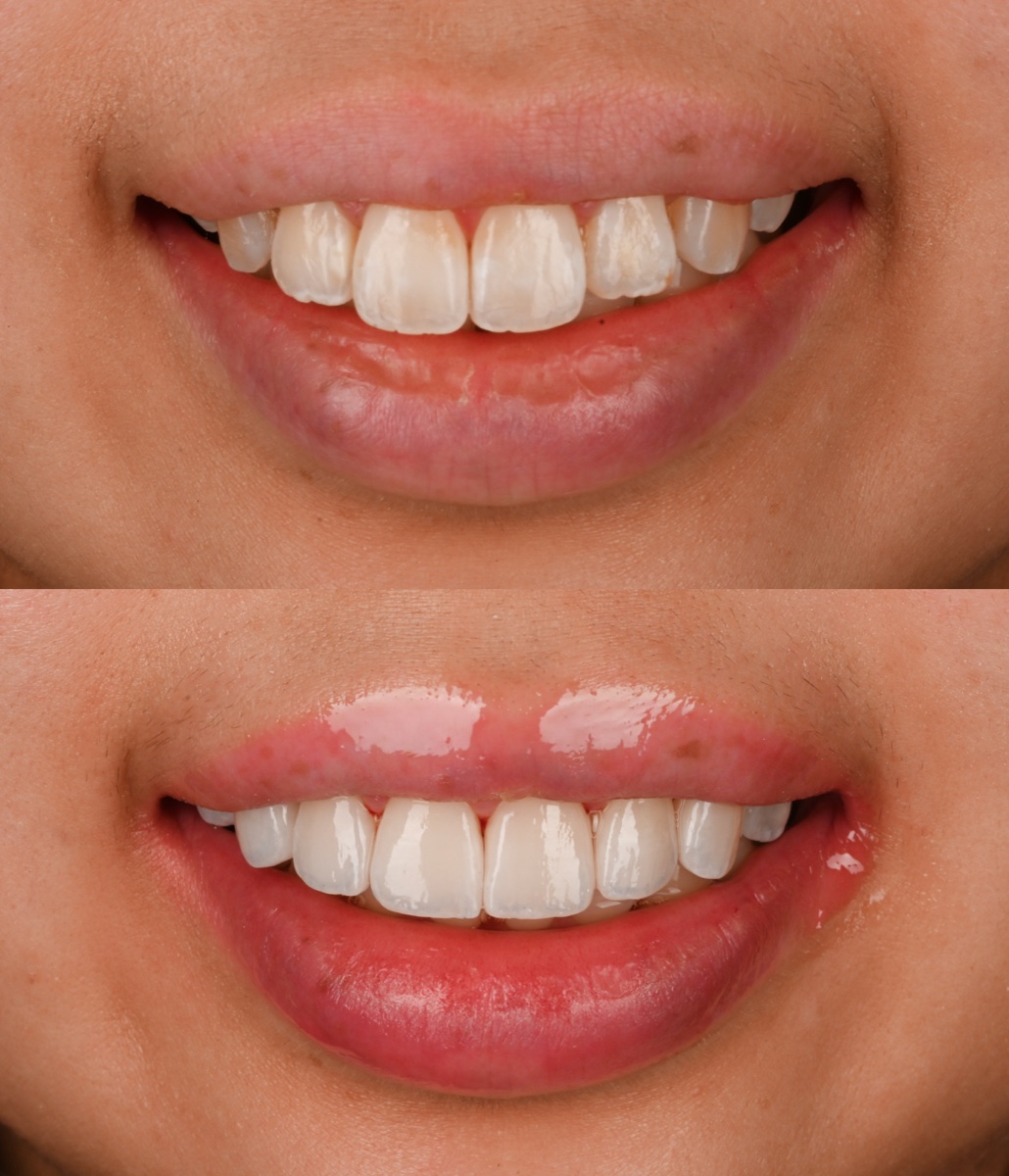 Veneers patient 2 patient, before and after