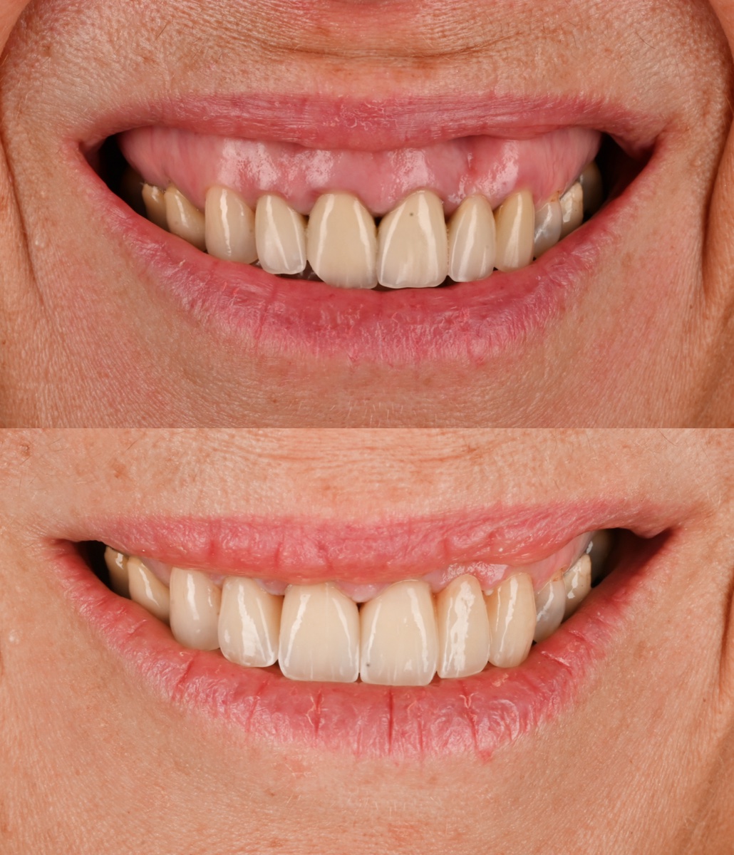 Veneers patient 3 patient, before and after