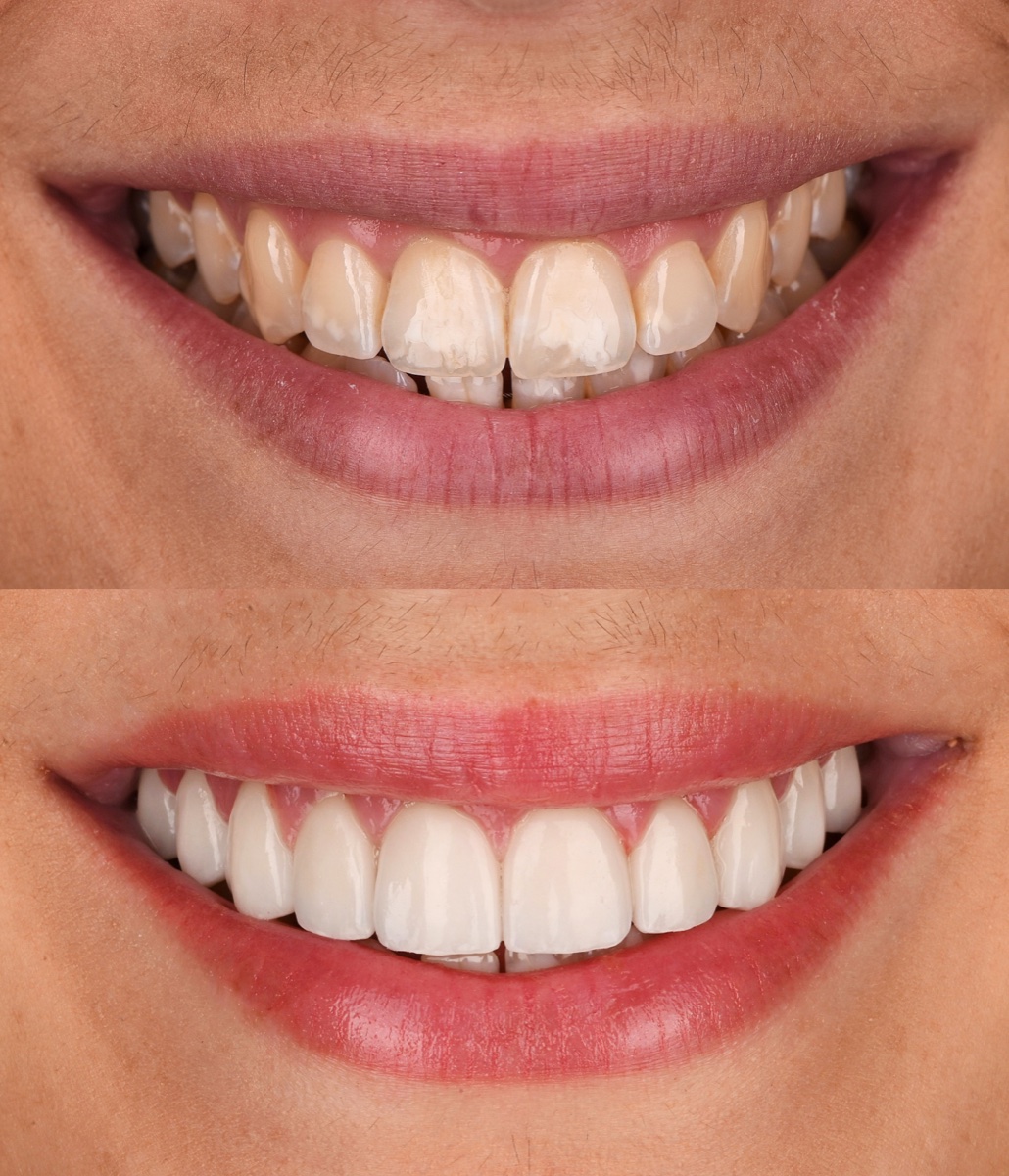 Veneers patient 4 patient, before and after