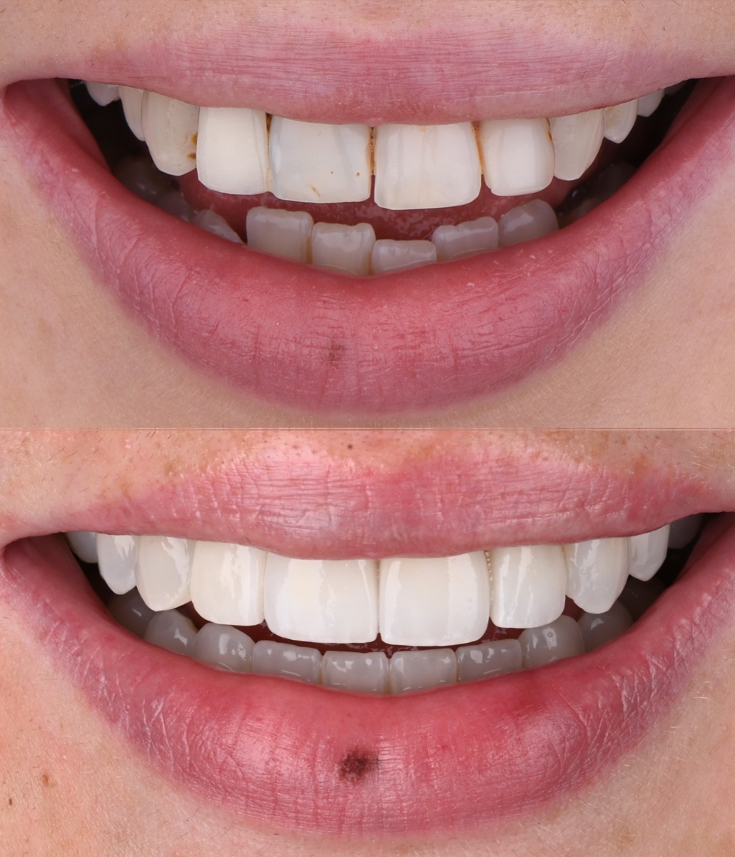 Veneers patient 5 patient, before and after