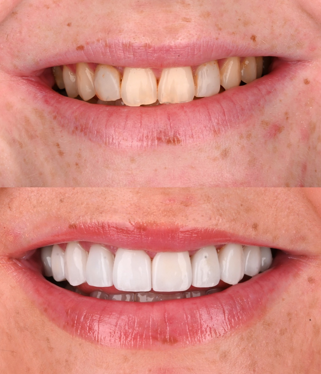 Veneers patient 6 patient, before and after
