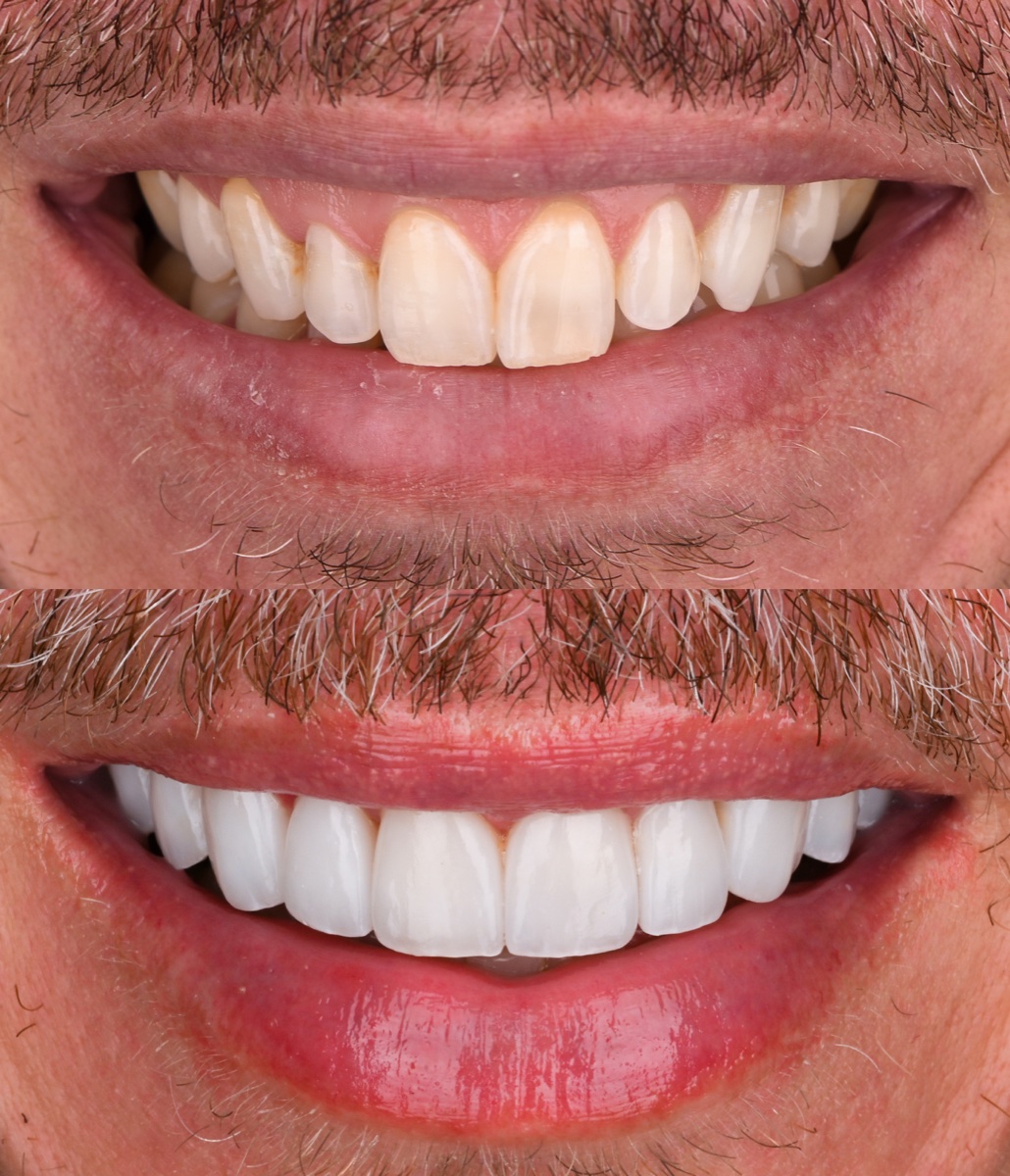 Veneers patient 7 patient, before and after