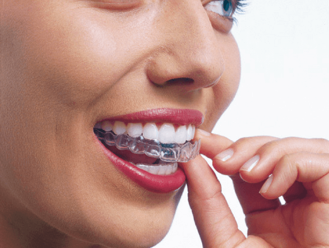 Is Invisalign Better Than Braces?, Dental Salon