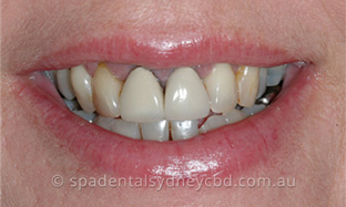 Cosmetic Dentistry in Spa Dental CBD