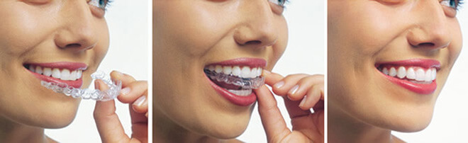 Invisalign in Sydney CBD